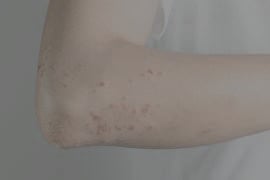 HIVES / SWELLING